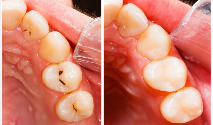 How to fill a hole in tooth at home? Is it safe