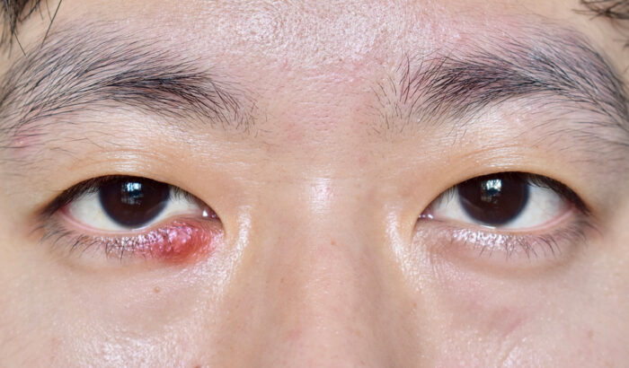 How does a chalazion drain naturally?
