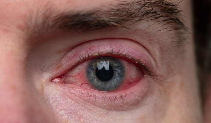 What is commonly misdiagnosed as pink eye?