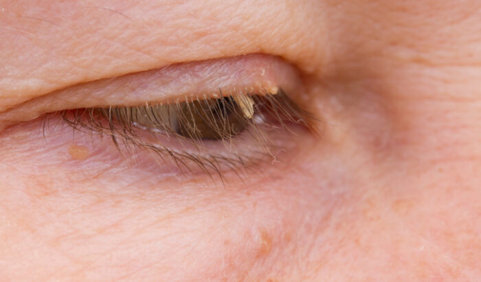 What causes eye skin tags