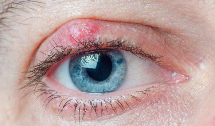 What is a chalazion?