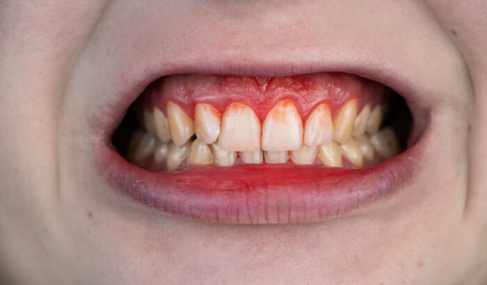 Emergency dental care: my gums are bleeding