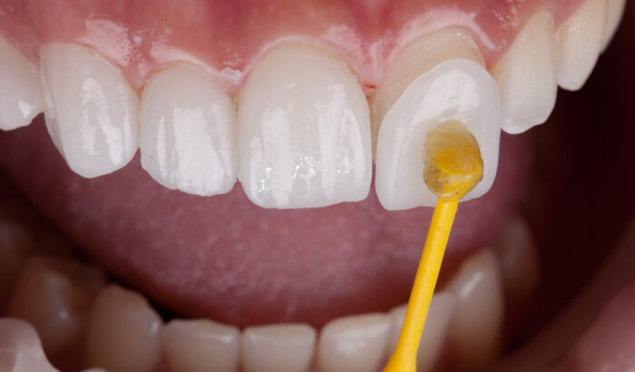What are porcelain veneers?