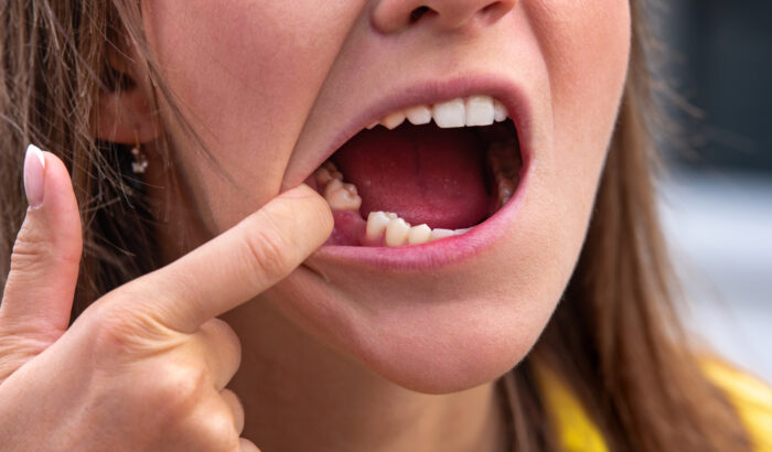 Young,Woman,Without,Tooth,On,Lower,Jaw.,Missing,Tooth.,Waiting