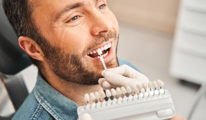 Do veneers stain