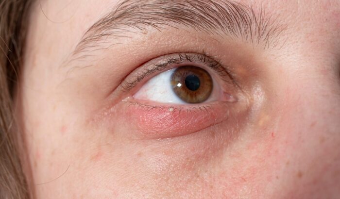 How to get rid of a chalazion