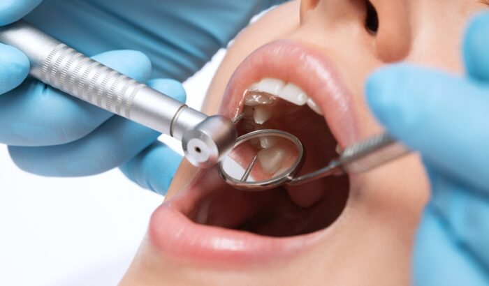How to fill gap after tooth extraction