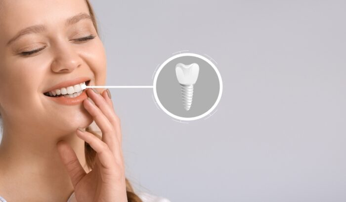 What are dental implants?