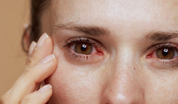 What causes dry eyes