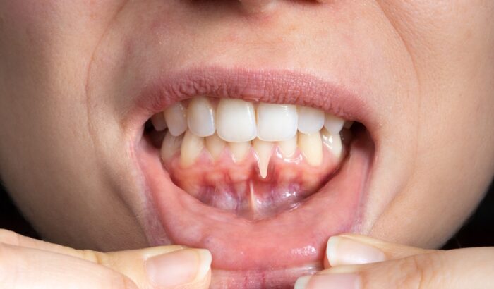 Can you have dental implants with receding gums UK?