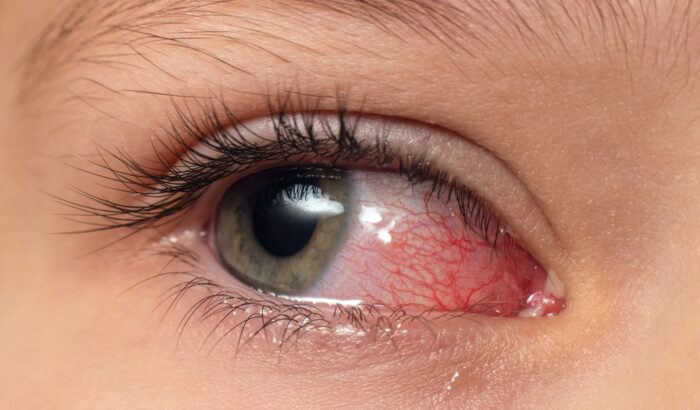 Are dry eyes a serious problem?