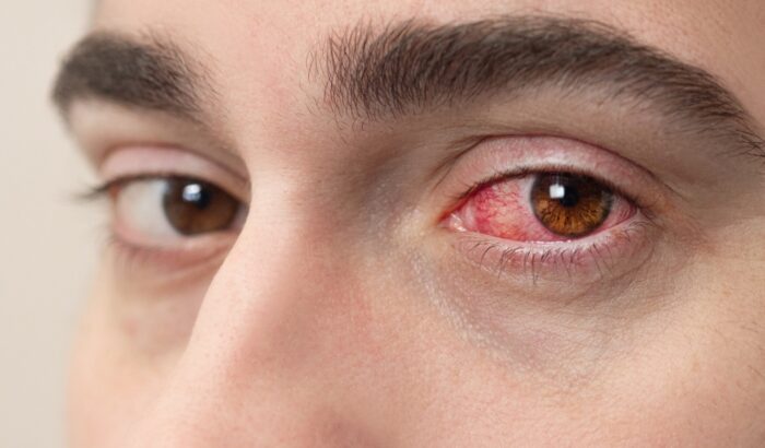 How can you contract Conjunctivitis?