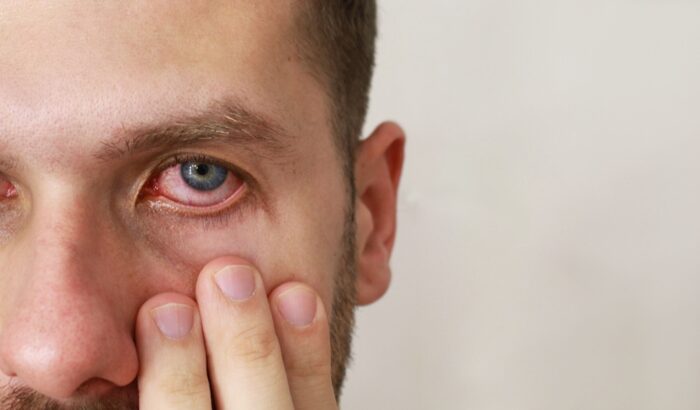Does Conjunctivitis heal on its own?