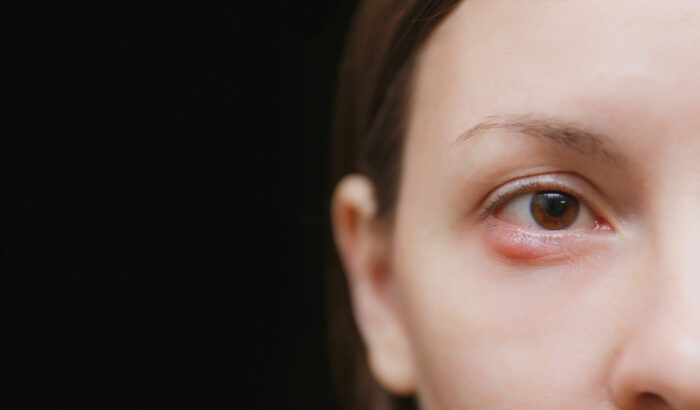 How long does a chalazion last?
