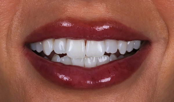 Smile Makeover Case 1 before