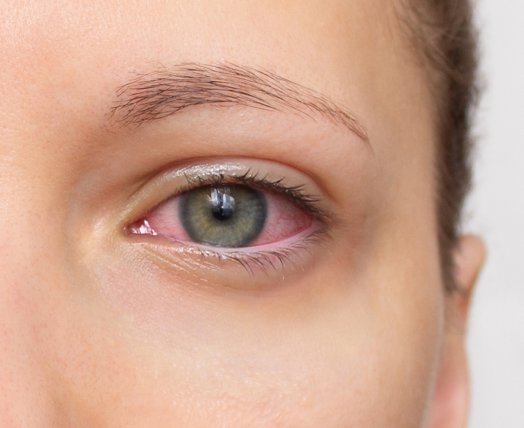 Symptoms of dry eyes